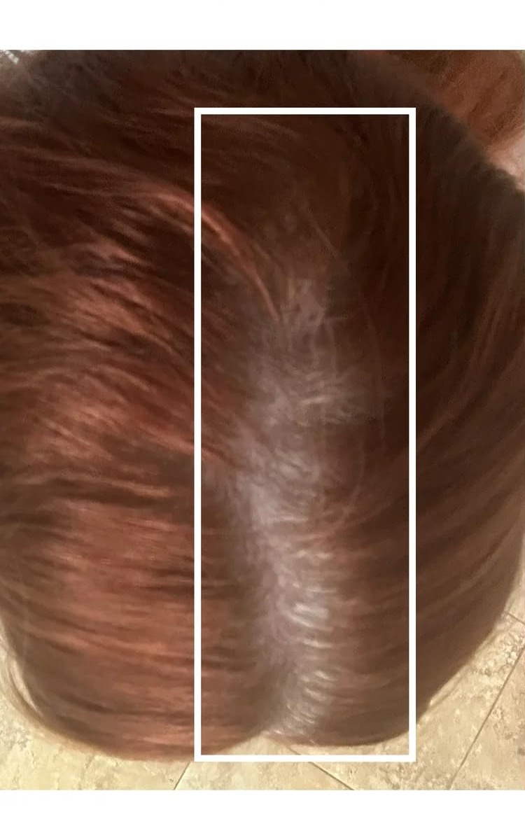 Before Reviru essential therapy